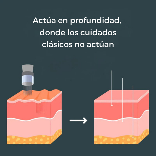 Micro-Infusión Lift Pro + Suero extra gratis